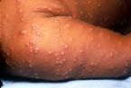 Smallpox infection